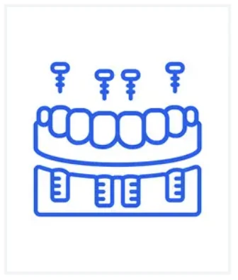 All-on-4 Implants